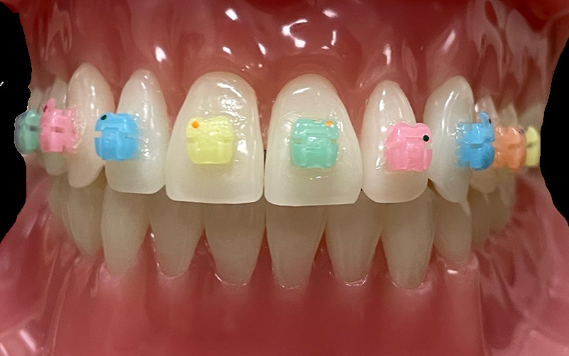 Candy Braces Happy Smiles with Colored Braces